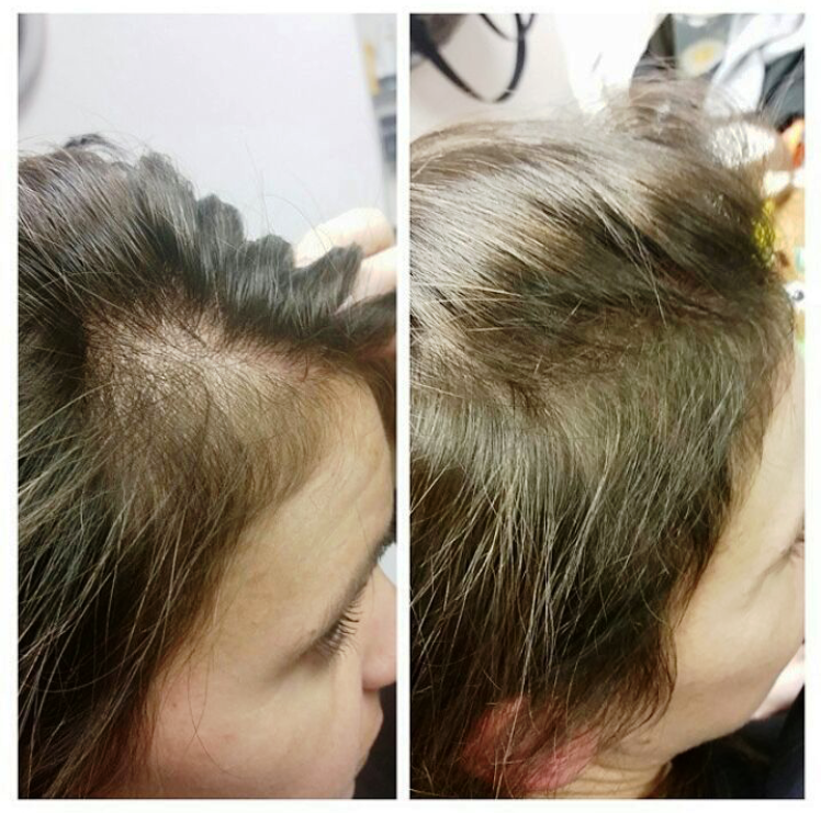 Actiiv Recover Before and After